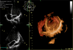 echocardiogram results